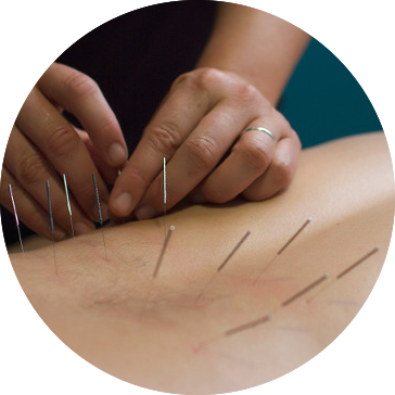 Western acupuncture / dry needling treatment
